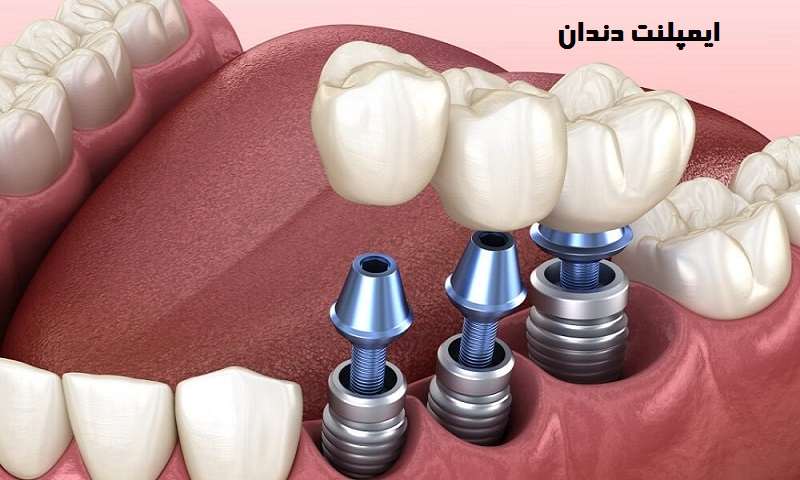 هزینه ایمپلنت دندان