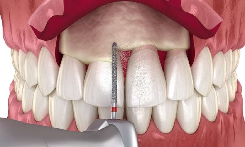 افزایش طول تاج دندان