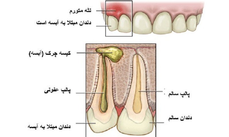 دارو برای آبسه دندان