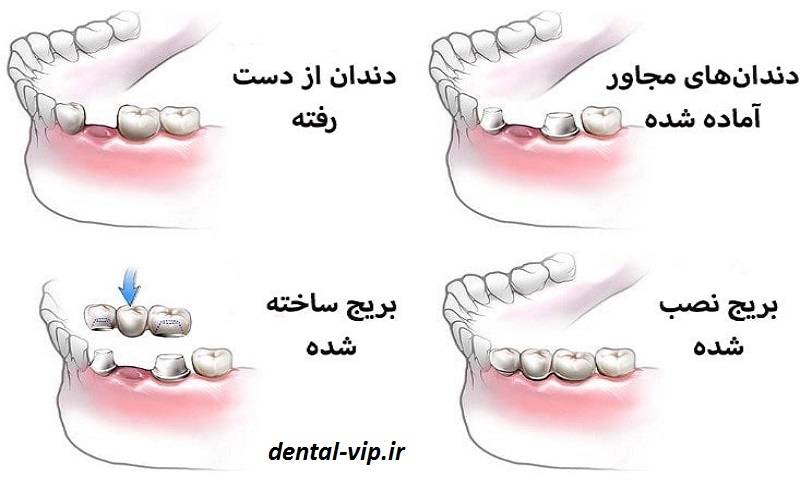 مراحل نصب بریج دندان