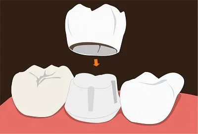قیمت روکش قیمت روکش