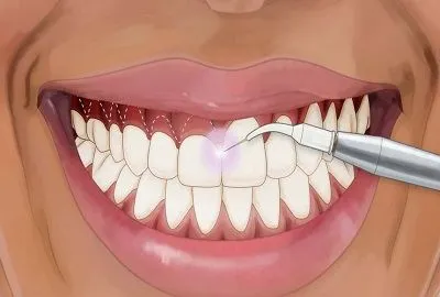 جراحی لیفت لثه جراحی لیفت لثه