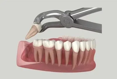 جراحی دندان عقل جراحی دندان عقل