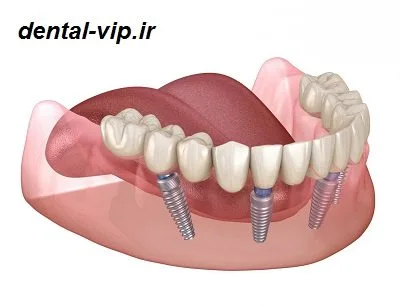 کاشت دندان طبیعی کاشت دندان طبیعی