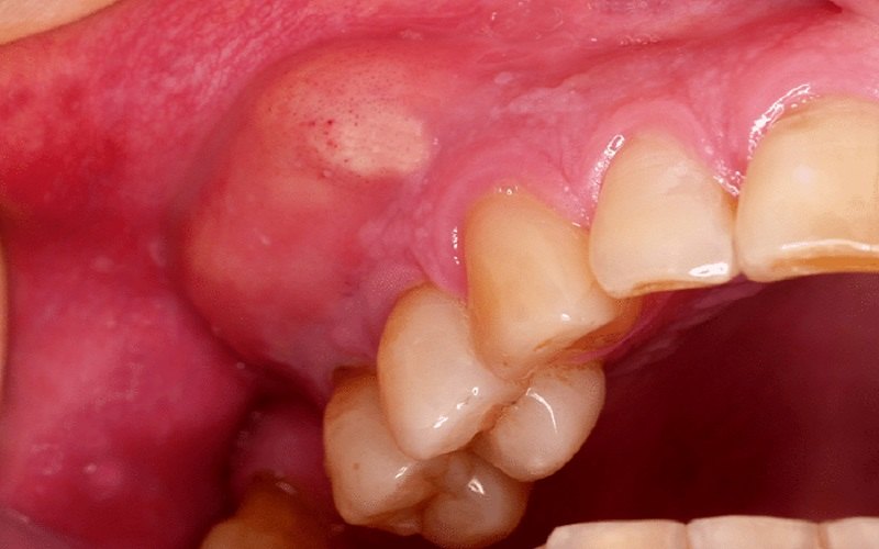 آبسه دندان - درمان فوری ورم صورت