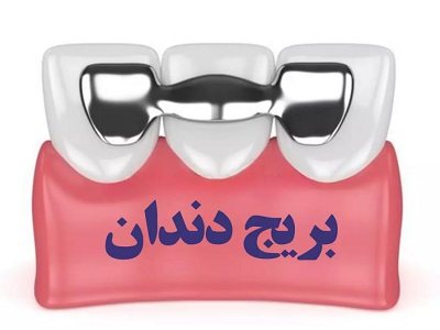 بریج دندانی