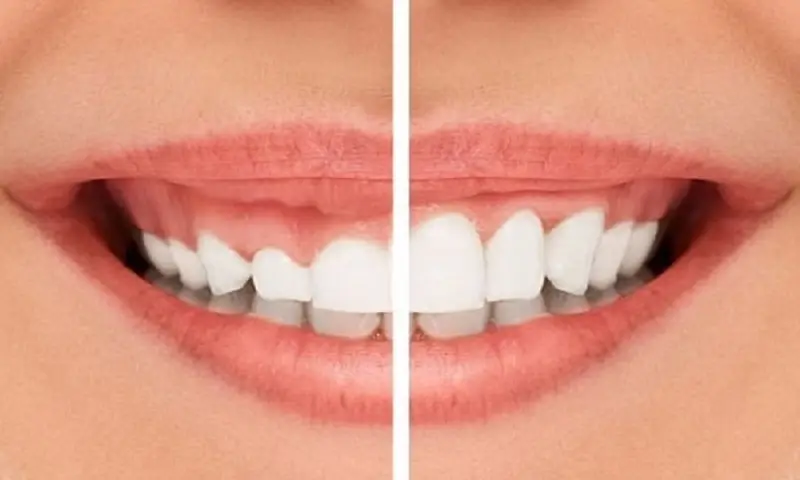 جراحی افزایش طول تاج دندان - بررسی هزینه