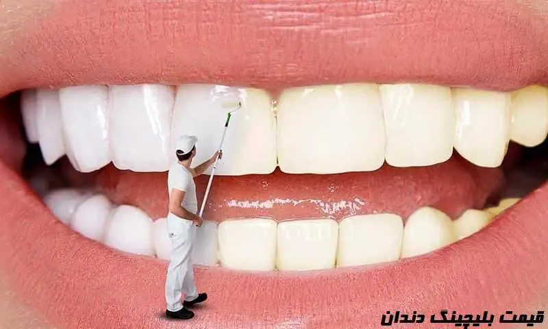 قیمت بلیچینگ دندان - تفاوت آن با جرمگیری 