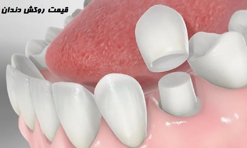 قیمت روکش دندان - بررسی انواع آن
